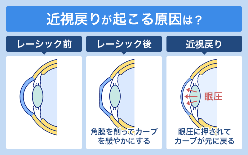 近視戻りが起こる原因は？