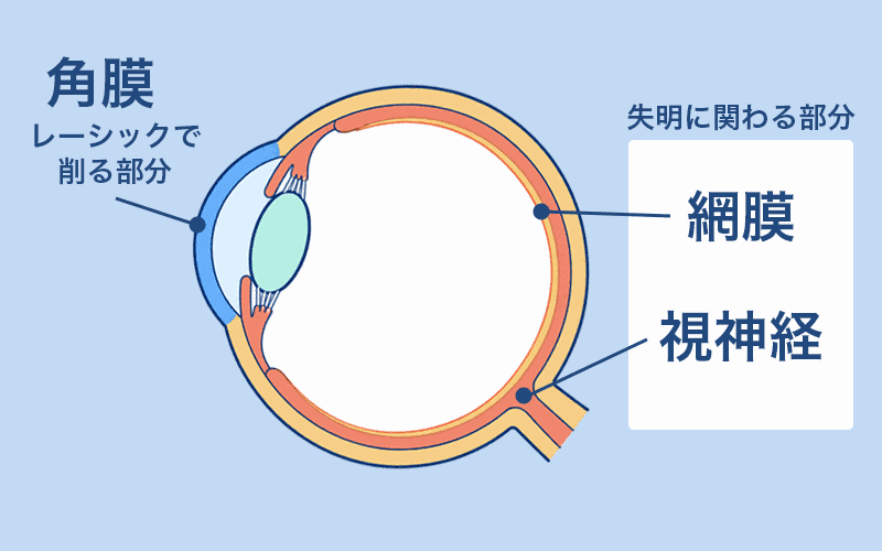 レーシックの失敗で失明する可能性はほとんどなし