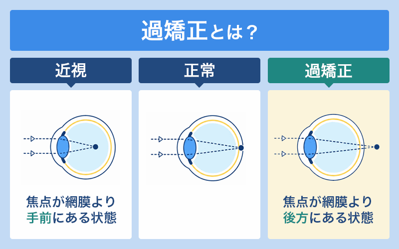 過矯正により遠視や眼精疲労が起こった