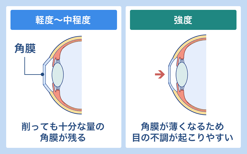 強度近視・強度乱視の人はレーシックでの合併症リスクが高い